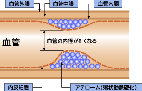 アテローム動脈硬化