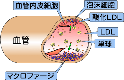 動脈硬化のできかた