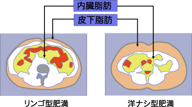 リンゴ型肥満、洋ナシ型肥満